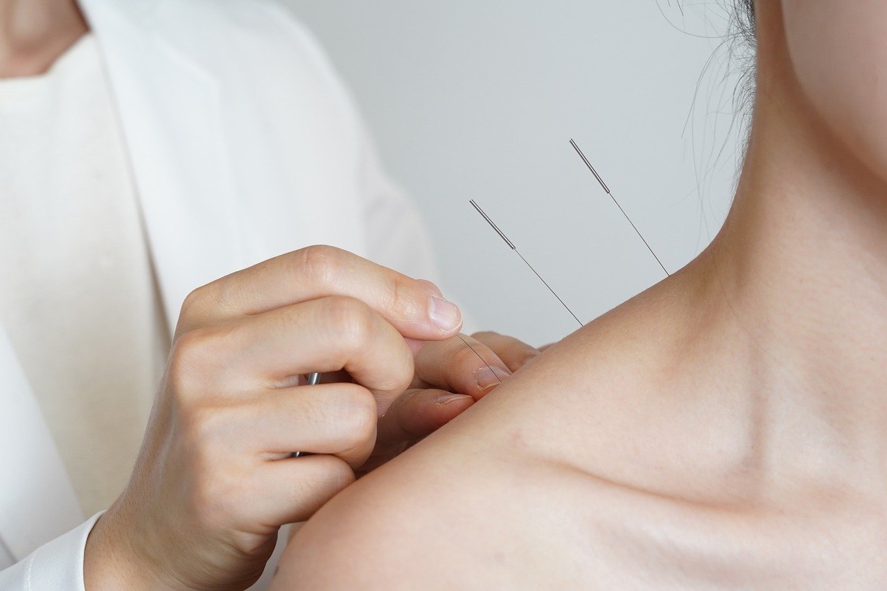 Home acupuncture pic